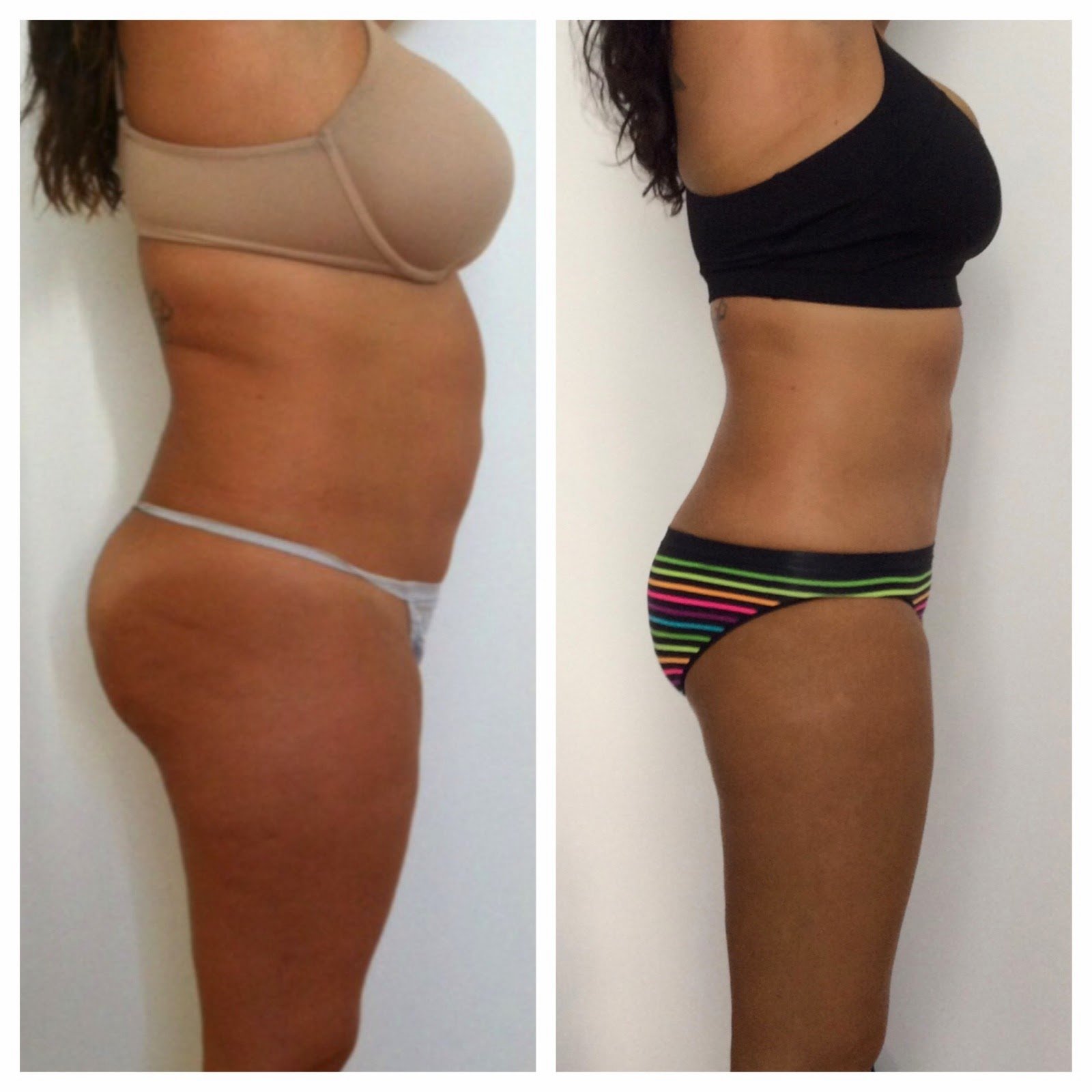 SAF Lipo and Ultra SAF Amazing reduction and tightening. Back to High School size!